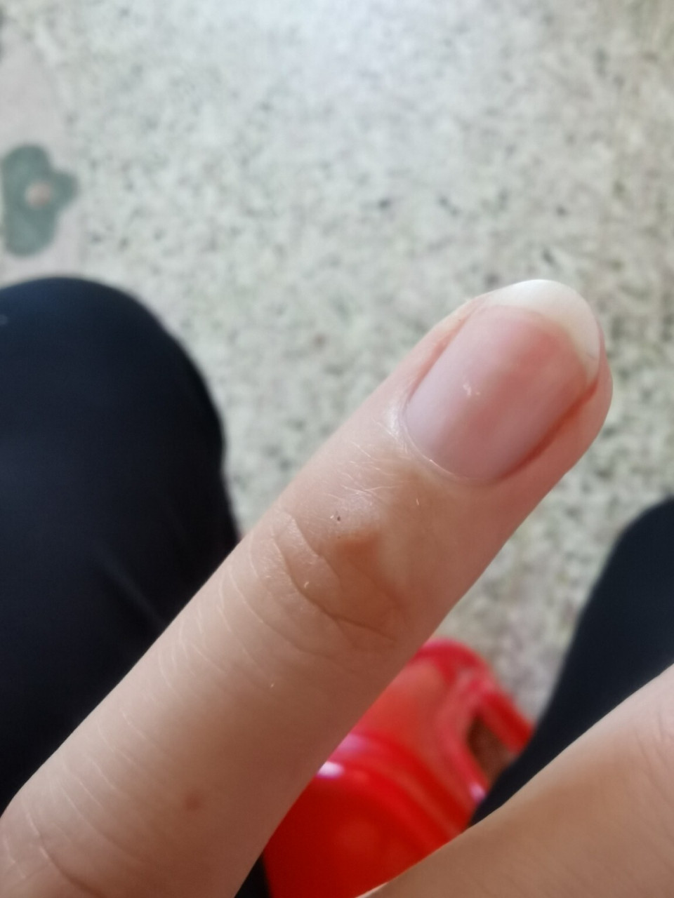 多年的疣终于好了97 家里人说是"鱼鳞痣",多年来反反复复的,每次长