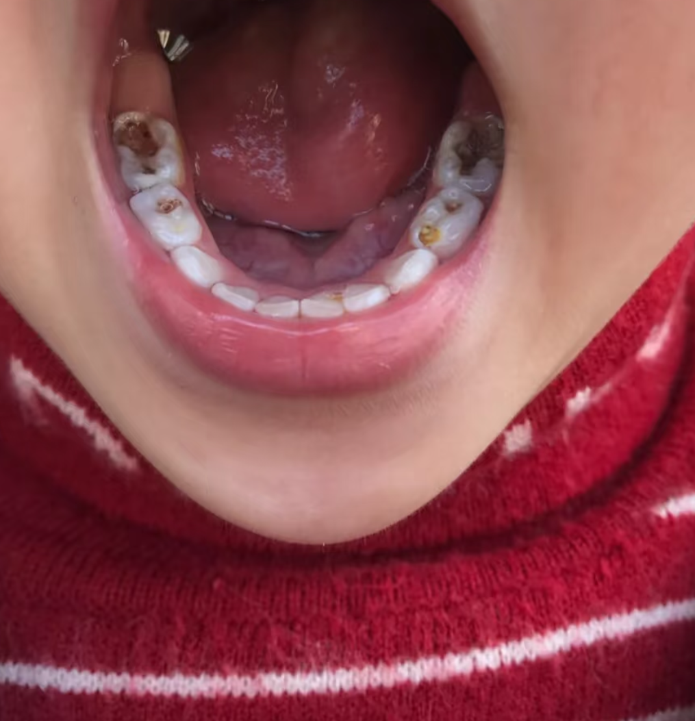 伤到牙神经是什么症状?