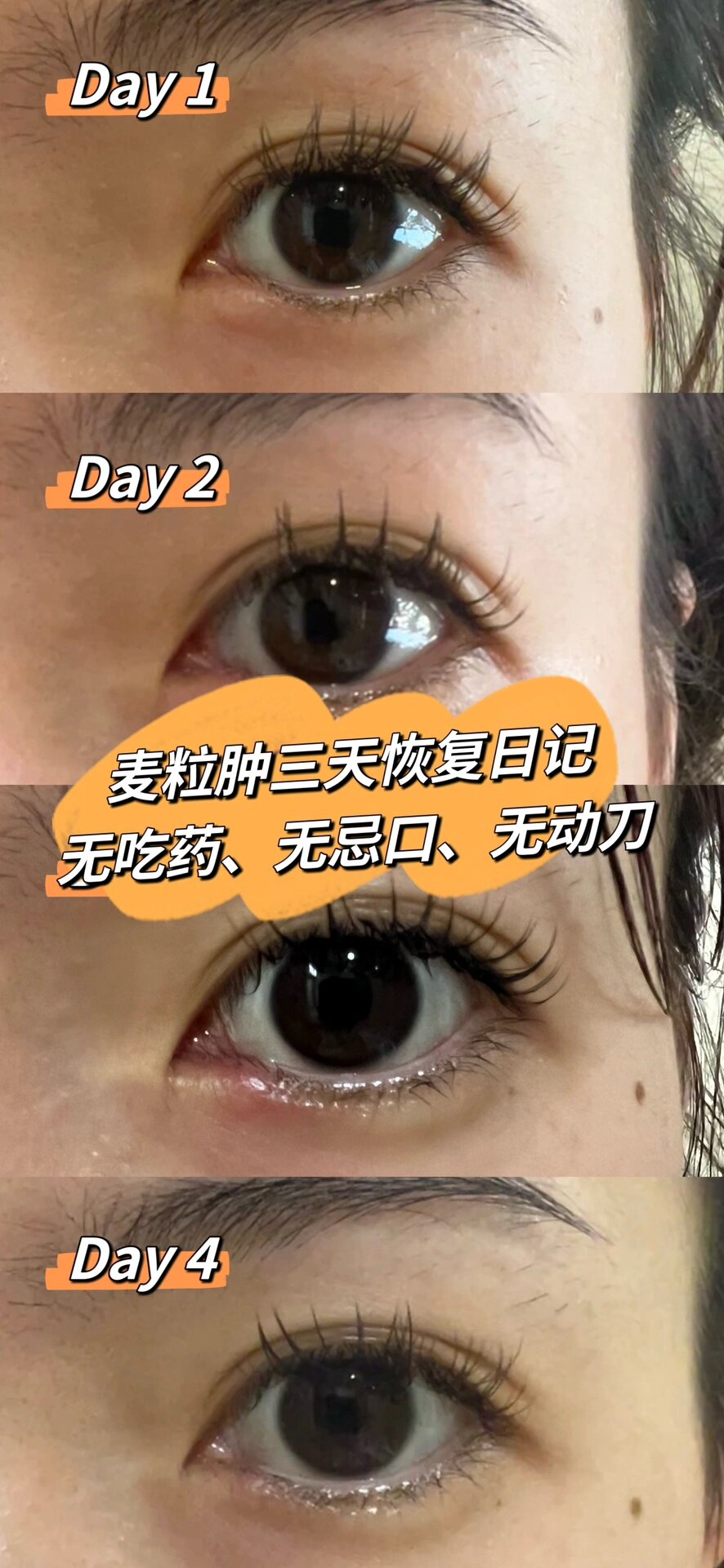 麦粒肿快速消肿妙招,三天无忌口迅速恢复