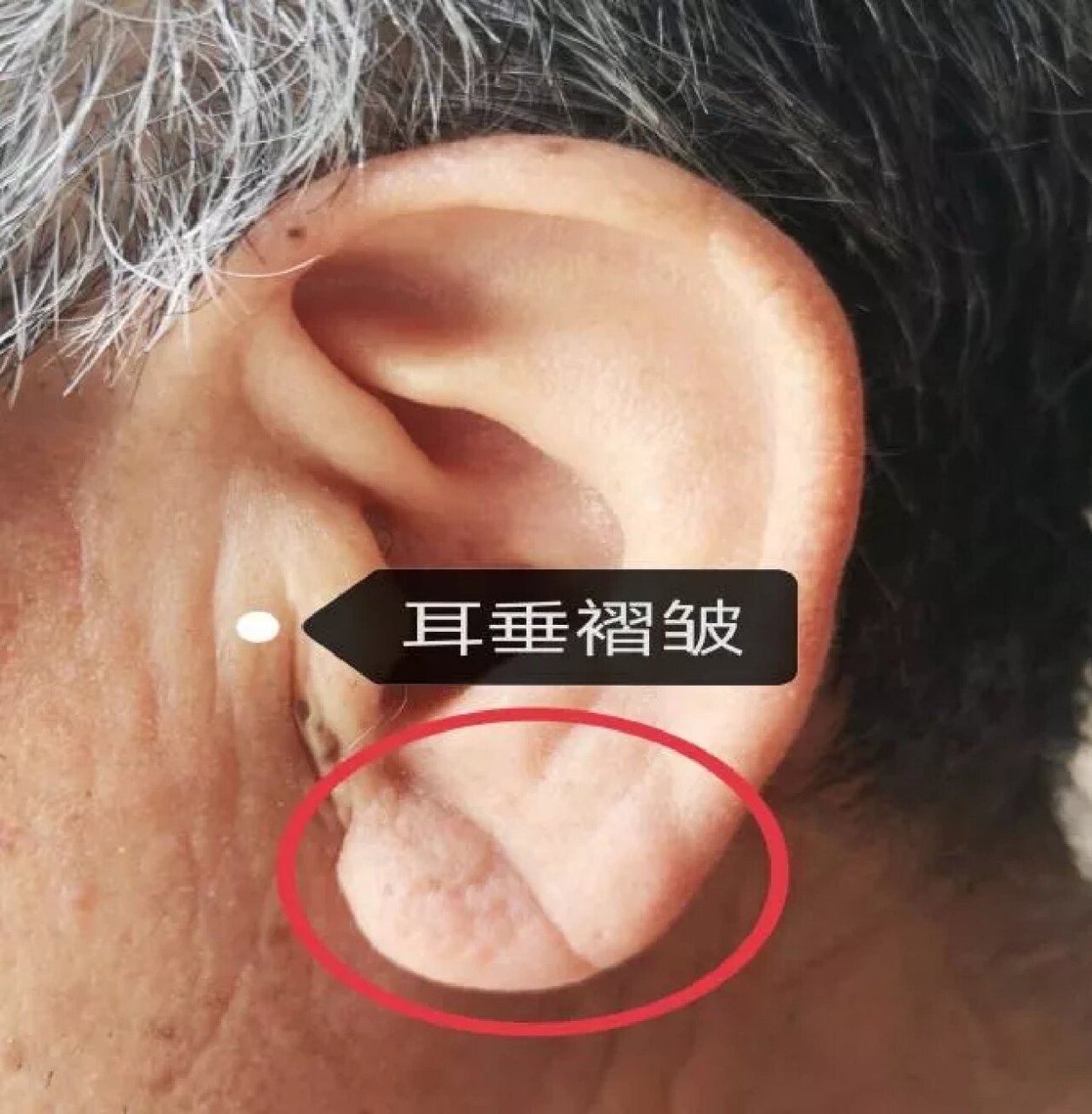 耳褶心征"是冠心病的重要征兆 正常人的耳垂是平洁光滑的.