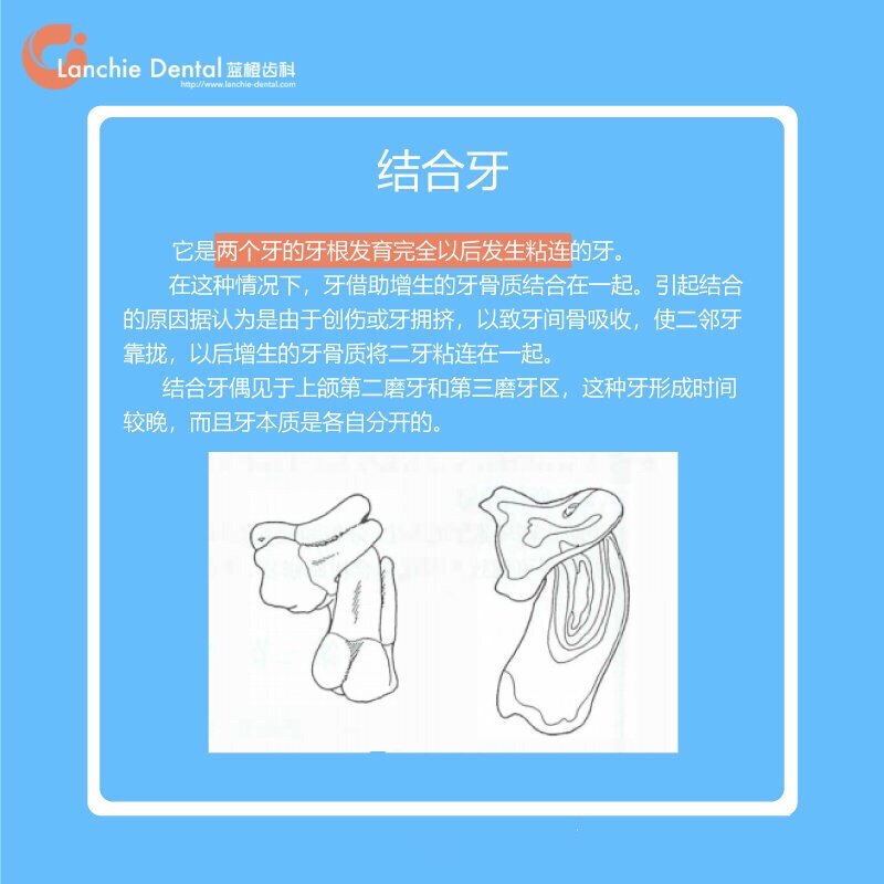 融合牙,双生牙,结合牙是个什么鬼?