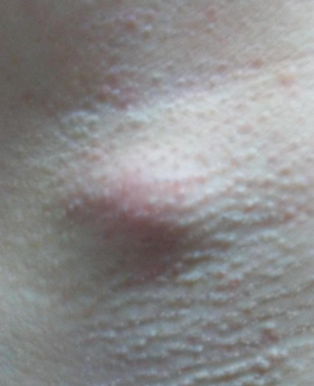 腋下有疙瘩常见于皮脂腺囊肿,腋下淋巴结肿大或脂肪瘤等问题