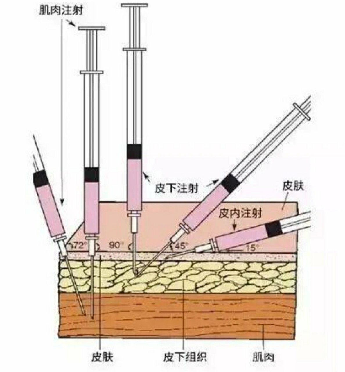 皮内注射角度图片