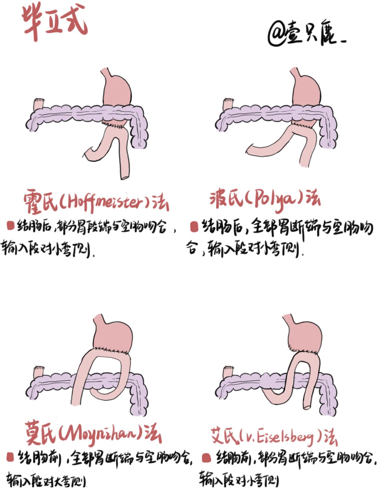 胃大部分切除手术图片