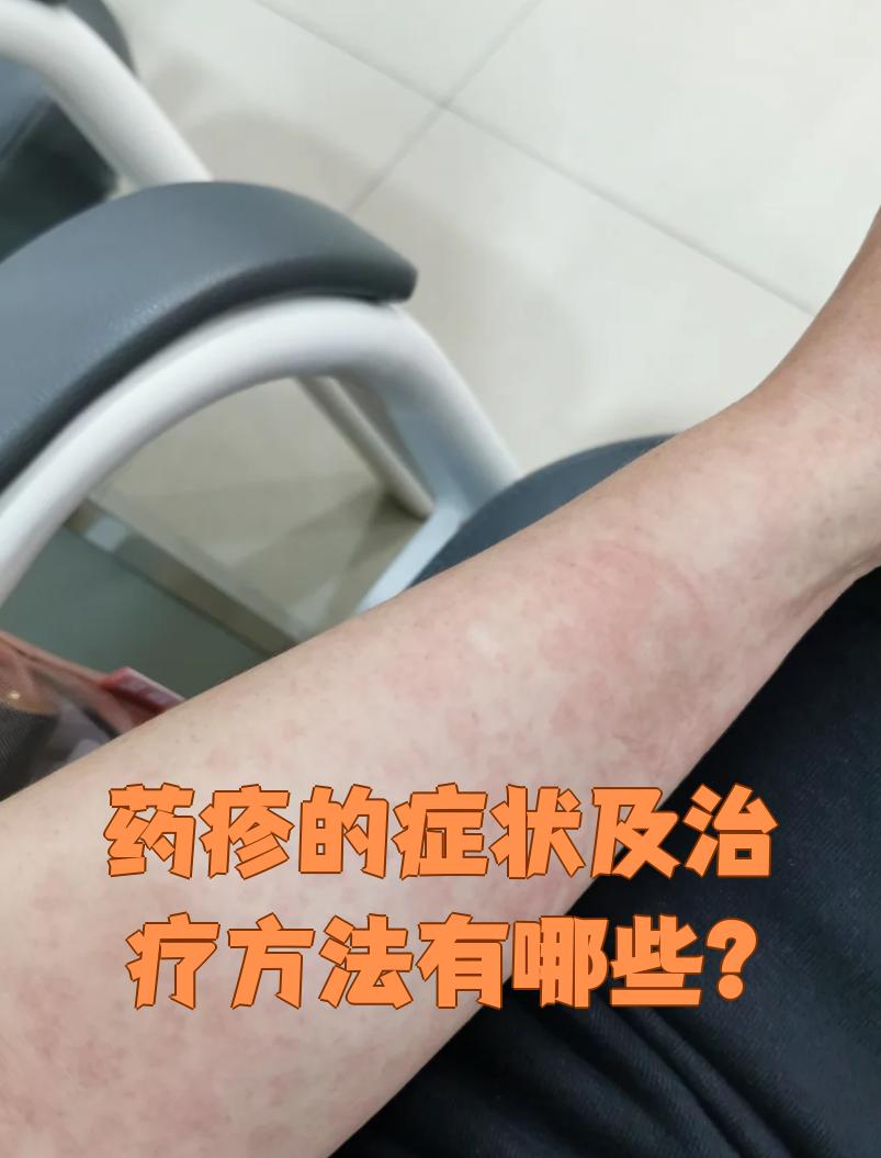 药疹的主要症状包括发疹,剥脱性皮炎和药物超敏综合征