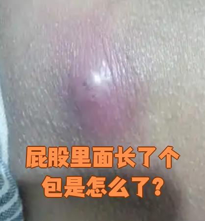 屁股里面长包可能由多种原因引起,常见的有毛囊炎,疖肿,皮脂腺囊肿