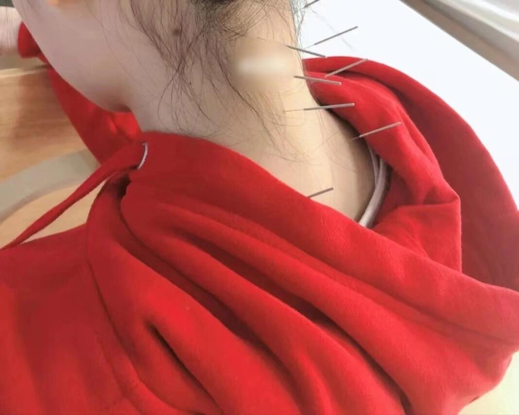 肩颈僵硬的可以去扎针灸,我总共去扎了3-4次,这半年来肩膀就很软 