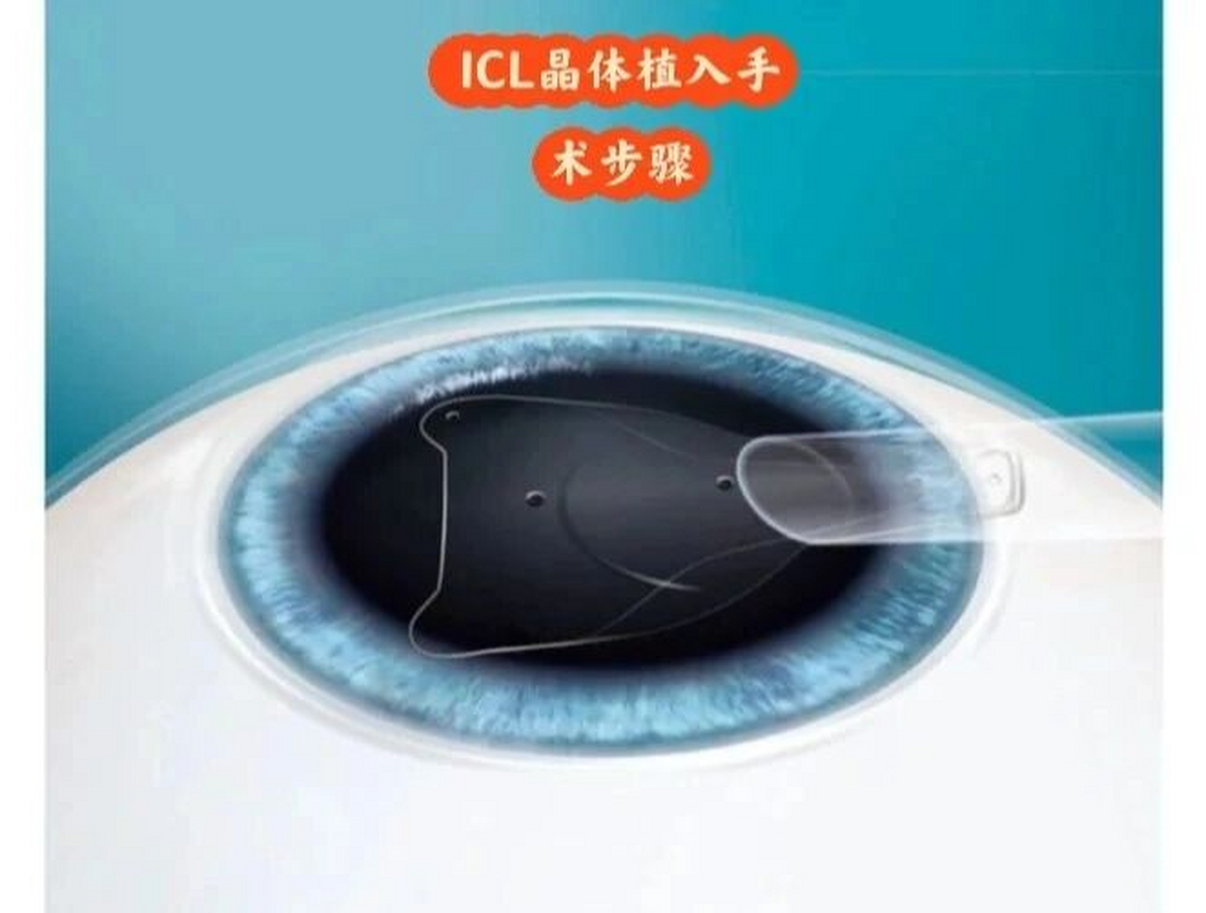 晶体植入手术的步骤 icl晶体植入手术怎么做?