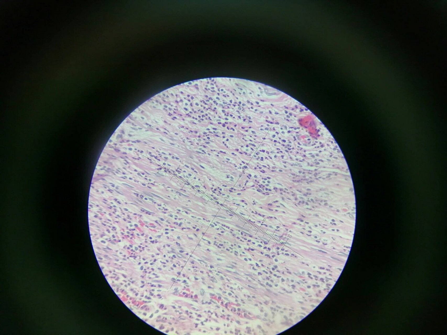 急性阑尾蜂窝织炎切片!