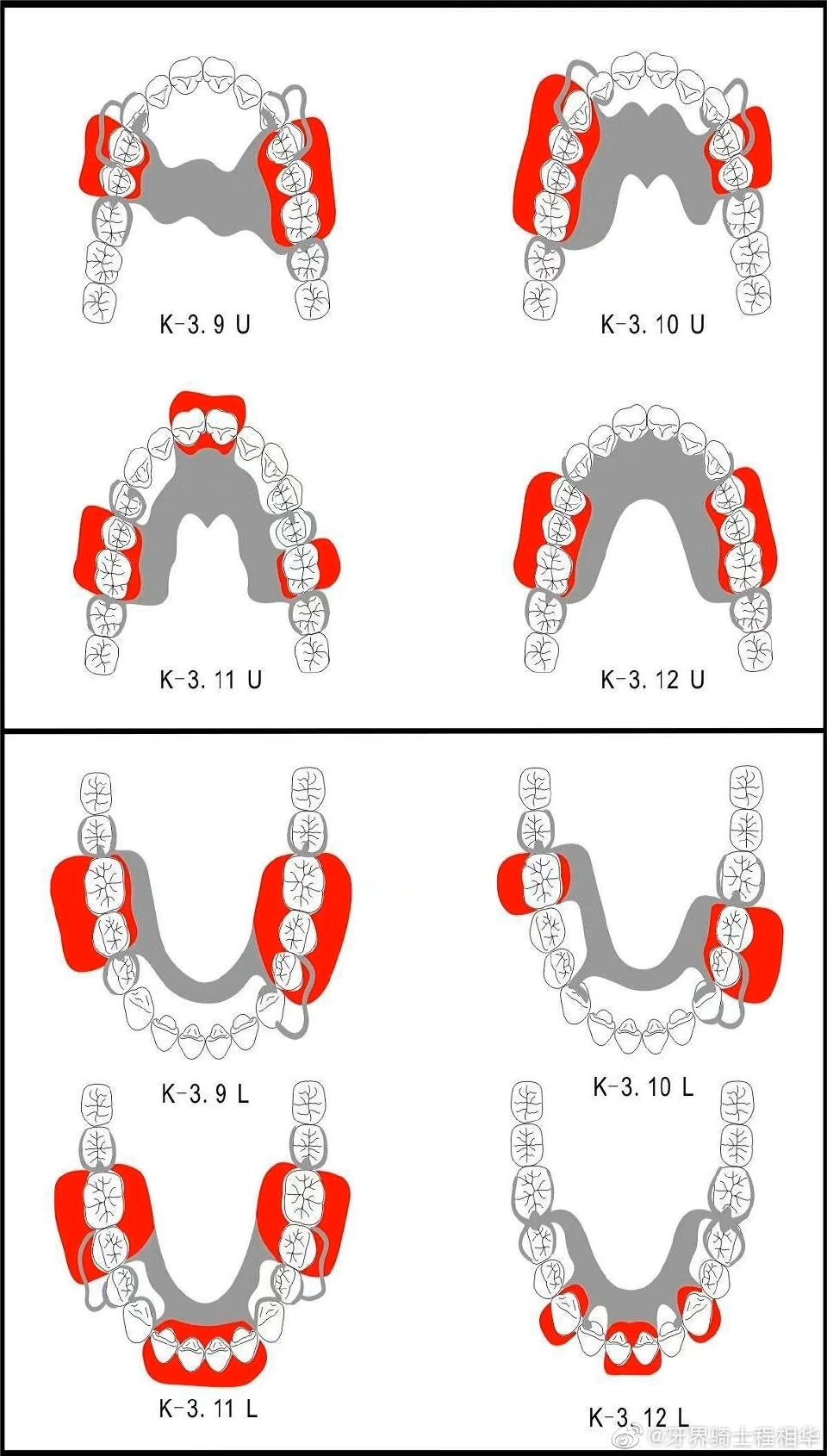活动义齿修复设计