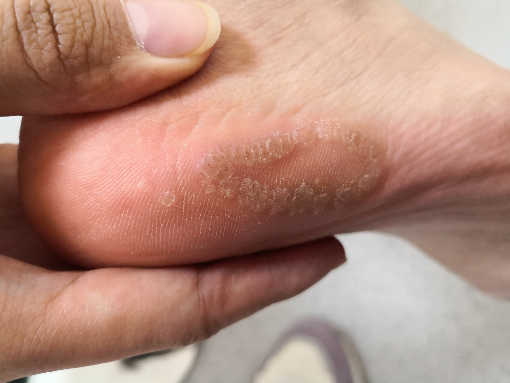 足底侧缘的环形排列的丘疹,中央有黑点,考虑跖疣.可以使用药物治疗.