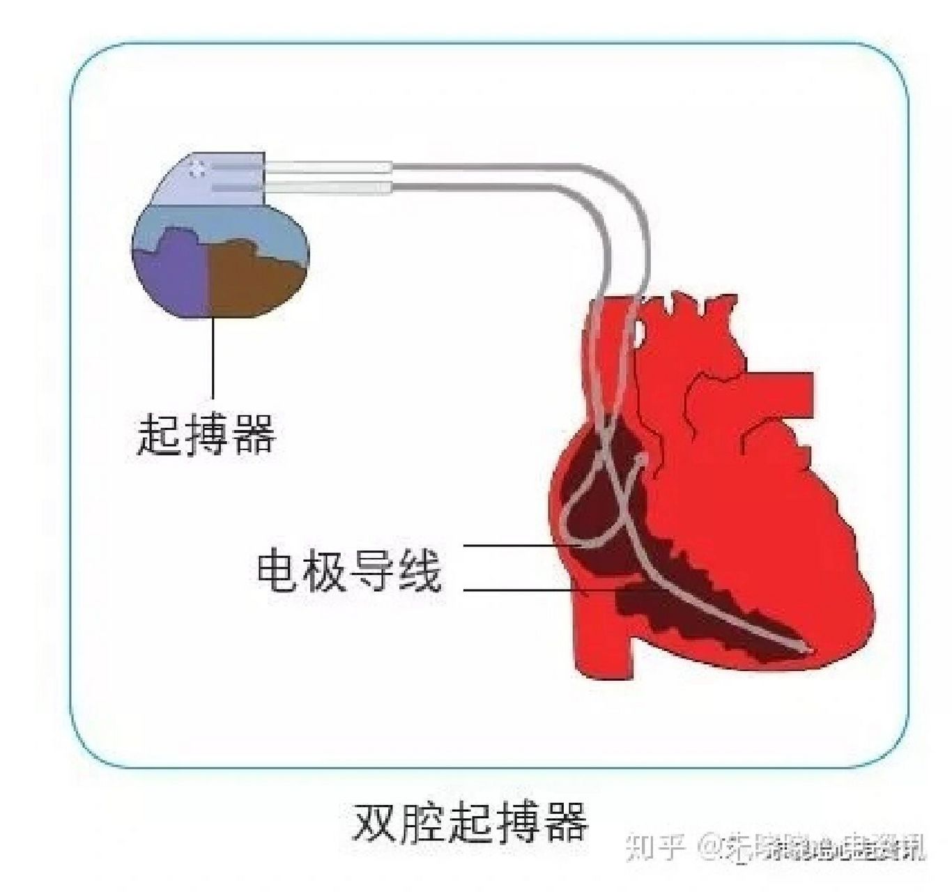 心脏不好,要安装起搏器,选什么型号的好?
