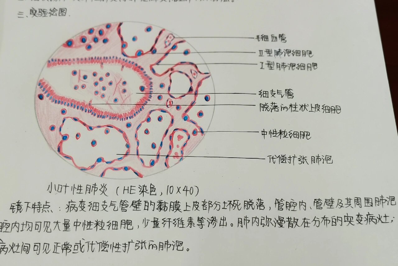 小叶性肺炎切片图片