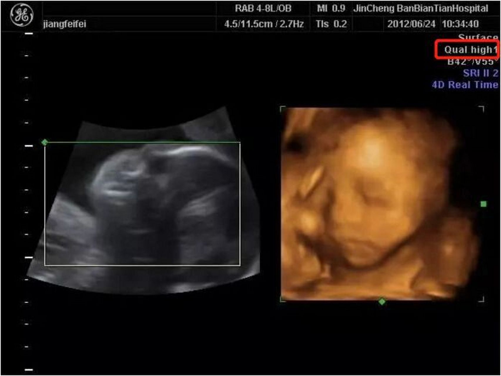 四维彩超的全称为四维彩色超声诊断仪,是世界上最先进的彩色超声设备