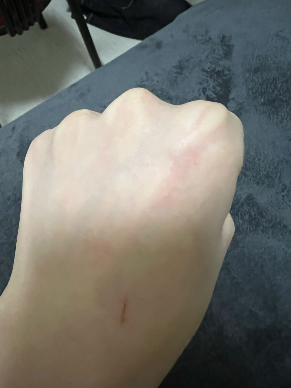 被自家狗爪子划破了需要打针吗