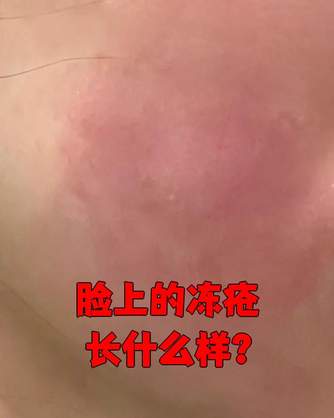 脸上冻疮的样子要看冻伤的严重程度,不同级别表现不一样