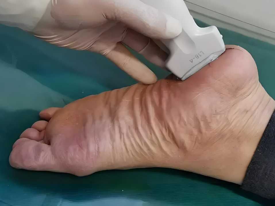 脚后跟外侧边缘痛常见原因有跟下脂肪垫炎,外伤和梨状肌综合征,不同