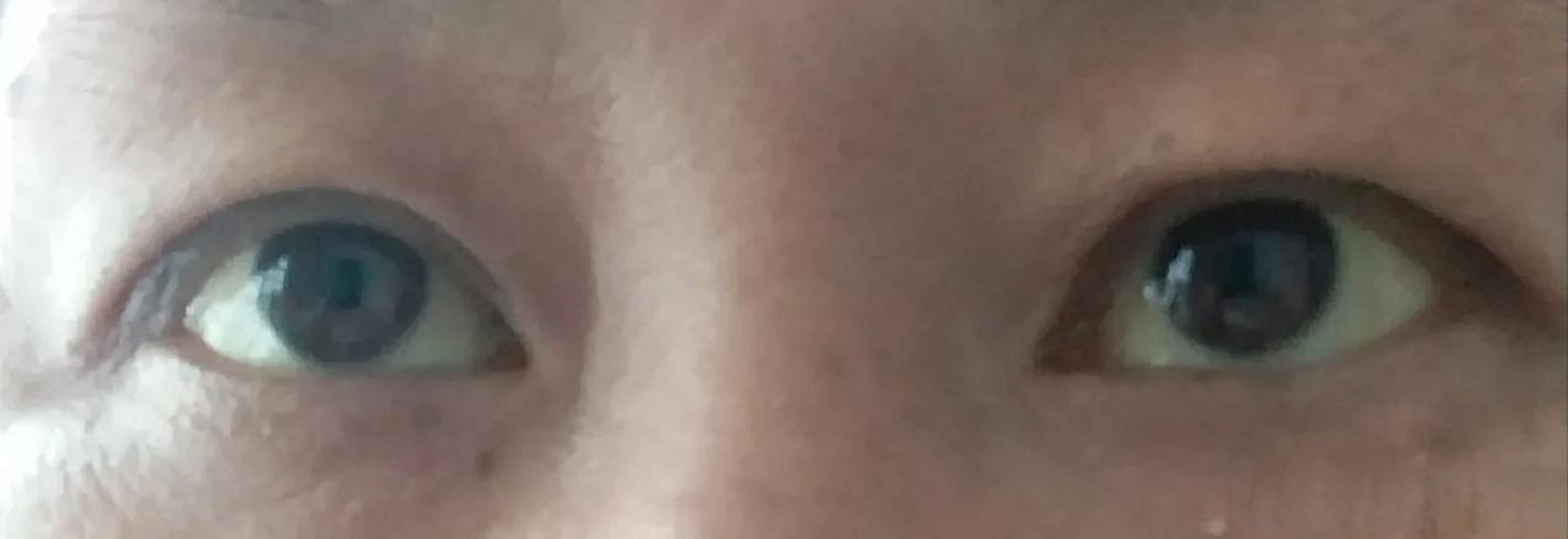 一见此眼即黄疸,一到医院就住院!