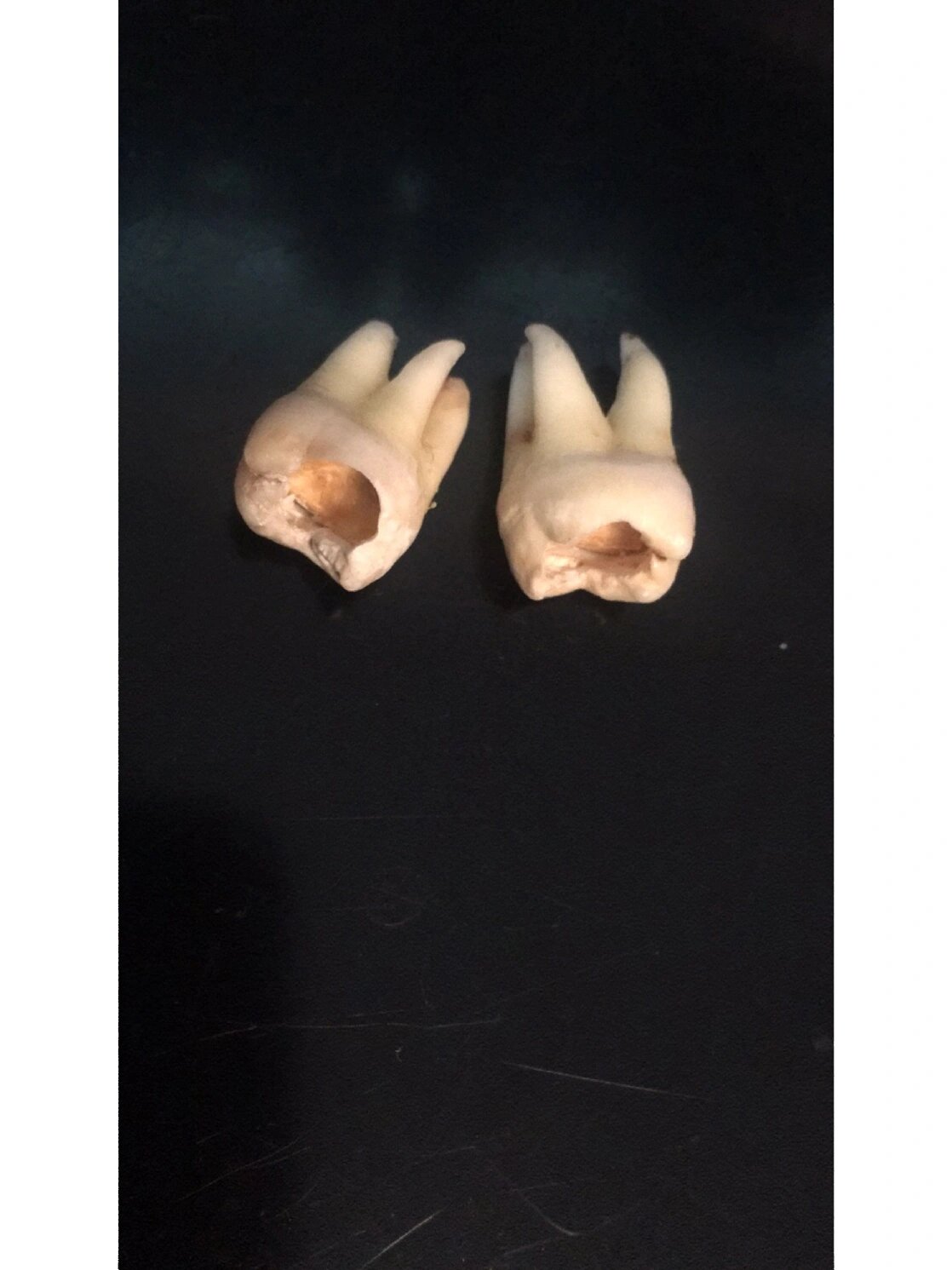 我的牙齿有三个根 甚至还有个倒钩