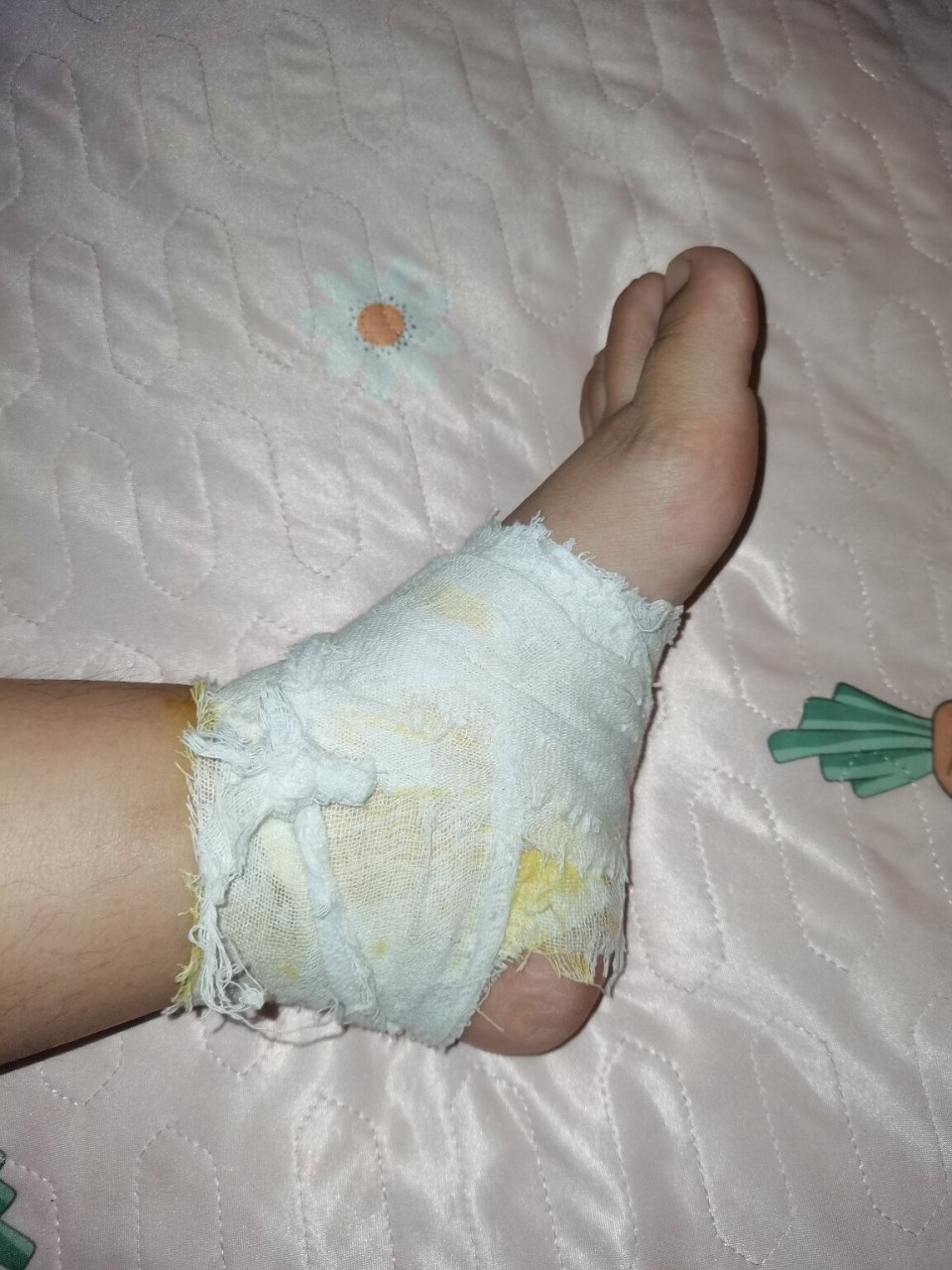 崴脚的两个月 不知道怎么弄的,第二天醒来感觉脚很涨 一看脚踝处肿了