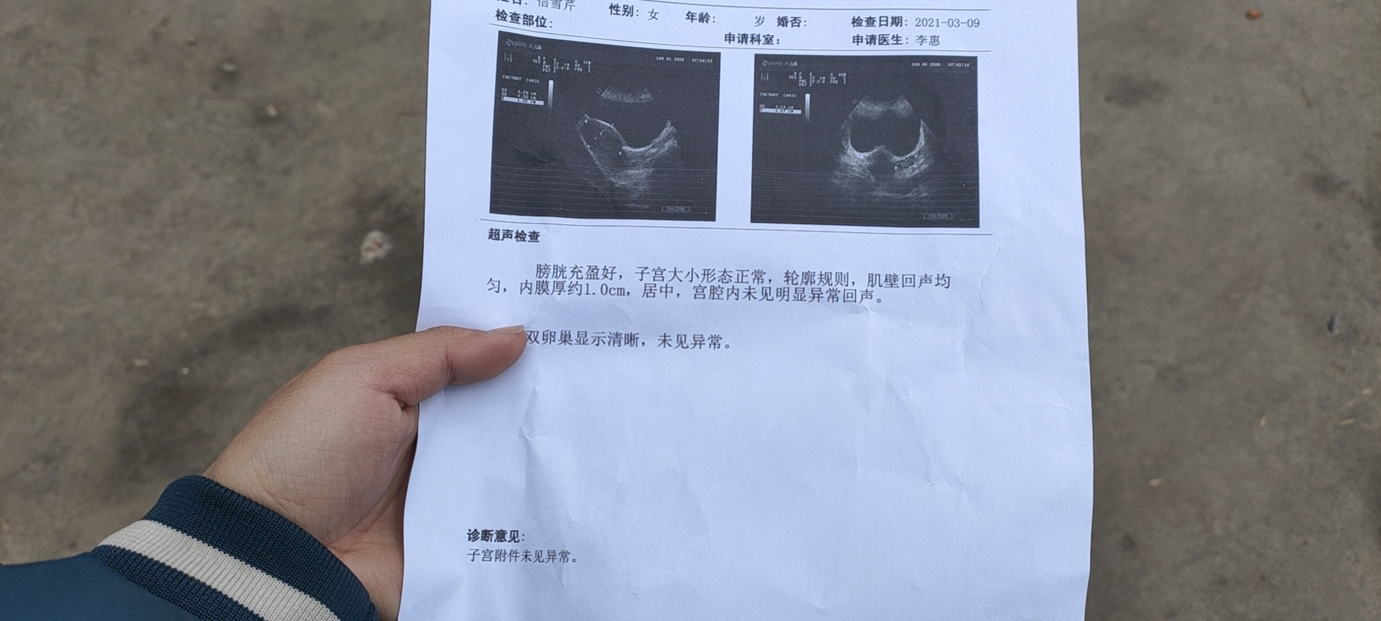 药流后有残留自己一直坚持不清宫 现在想想排残的日子