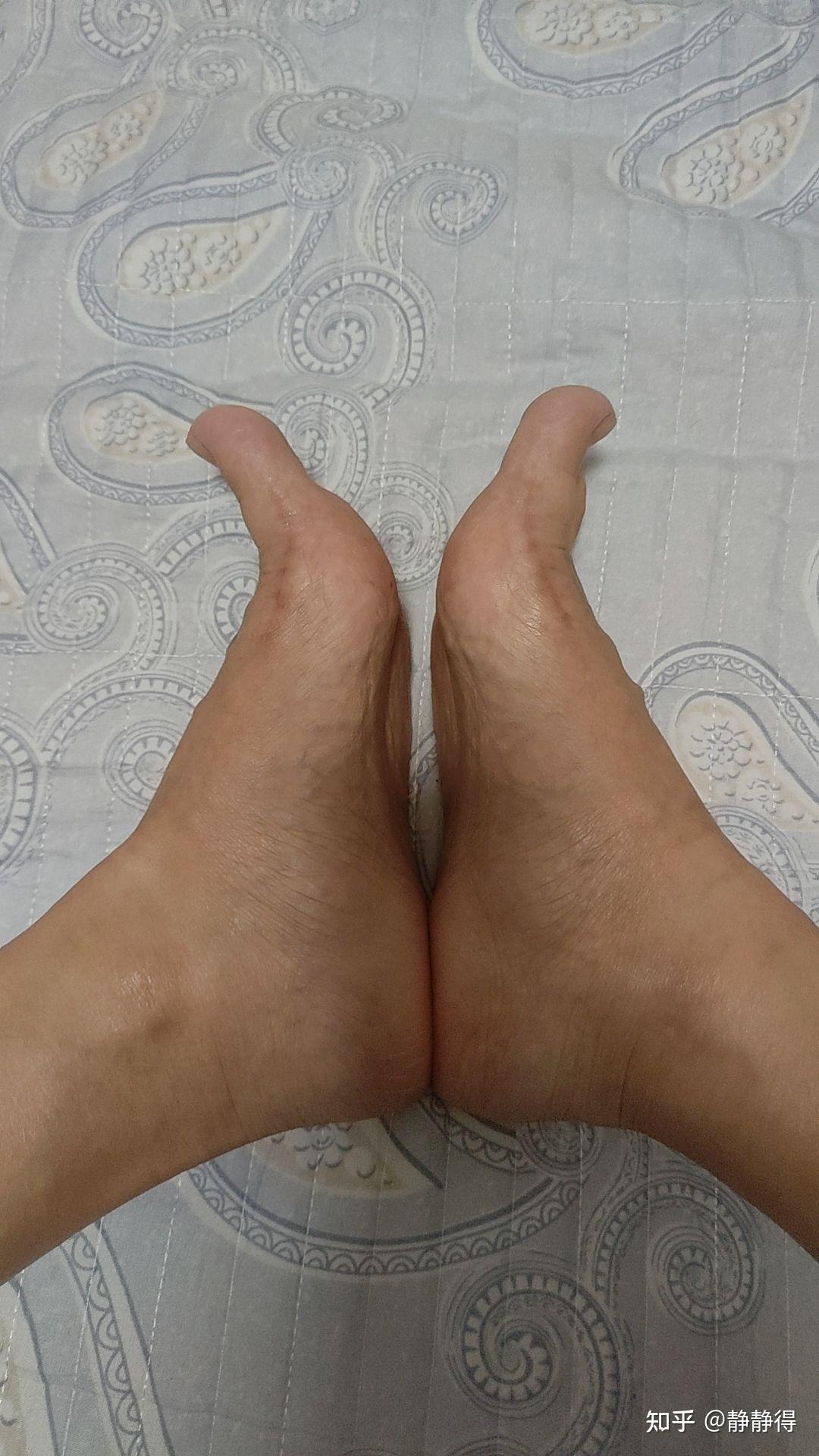 拇外翻大脚骨截骨手术后半年