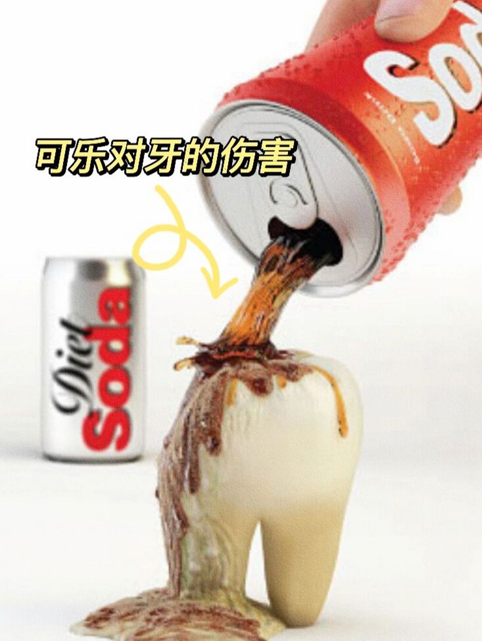 可乐对牙齿的伤害超出你想象98 牙齿酸蚀症,是可乐等碳酸饮料引起