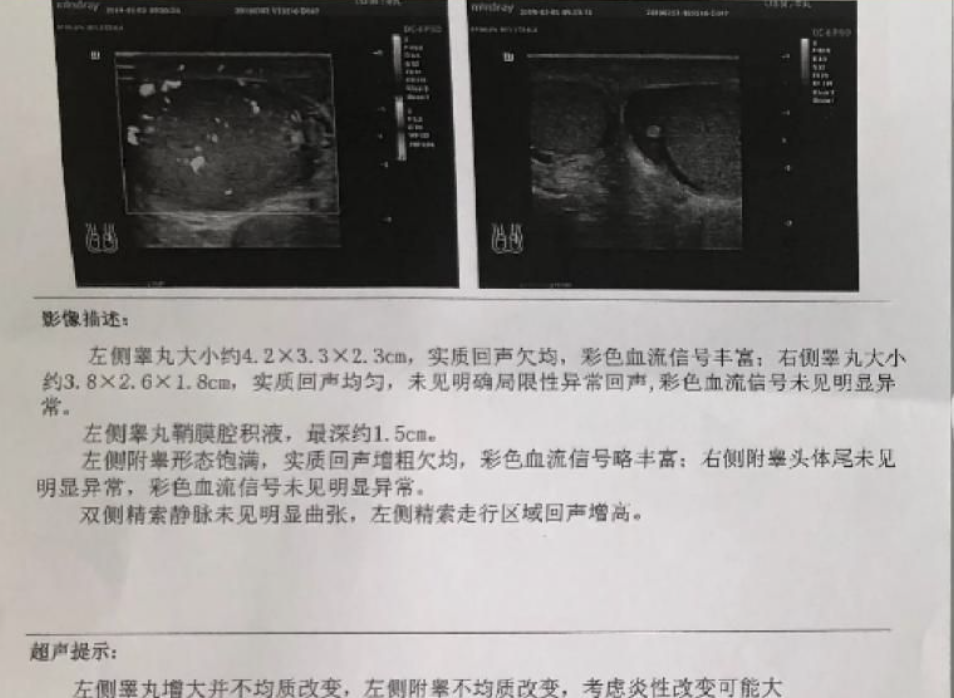 男人绝育后,最常见的问题是附睾精子淤积,严重时可能引发睾丸炎症