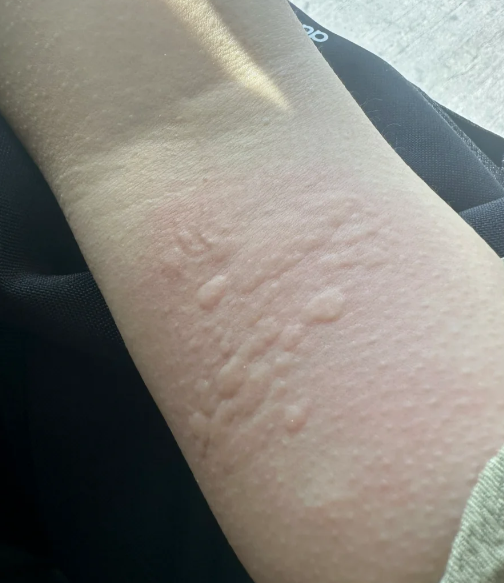 手臂一挠就起很多小红点,这种情况很可能是荨麻疹