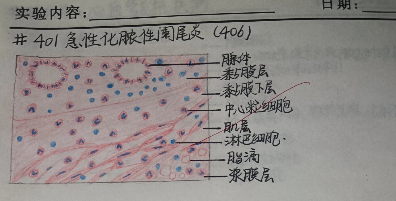 急性化脓性阑尾炎