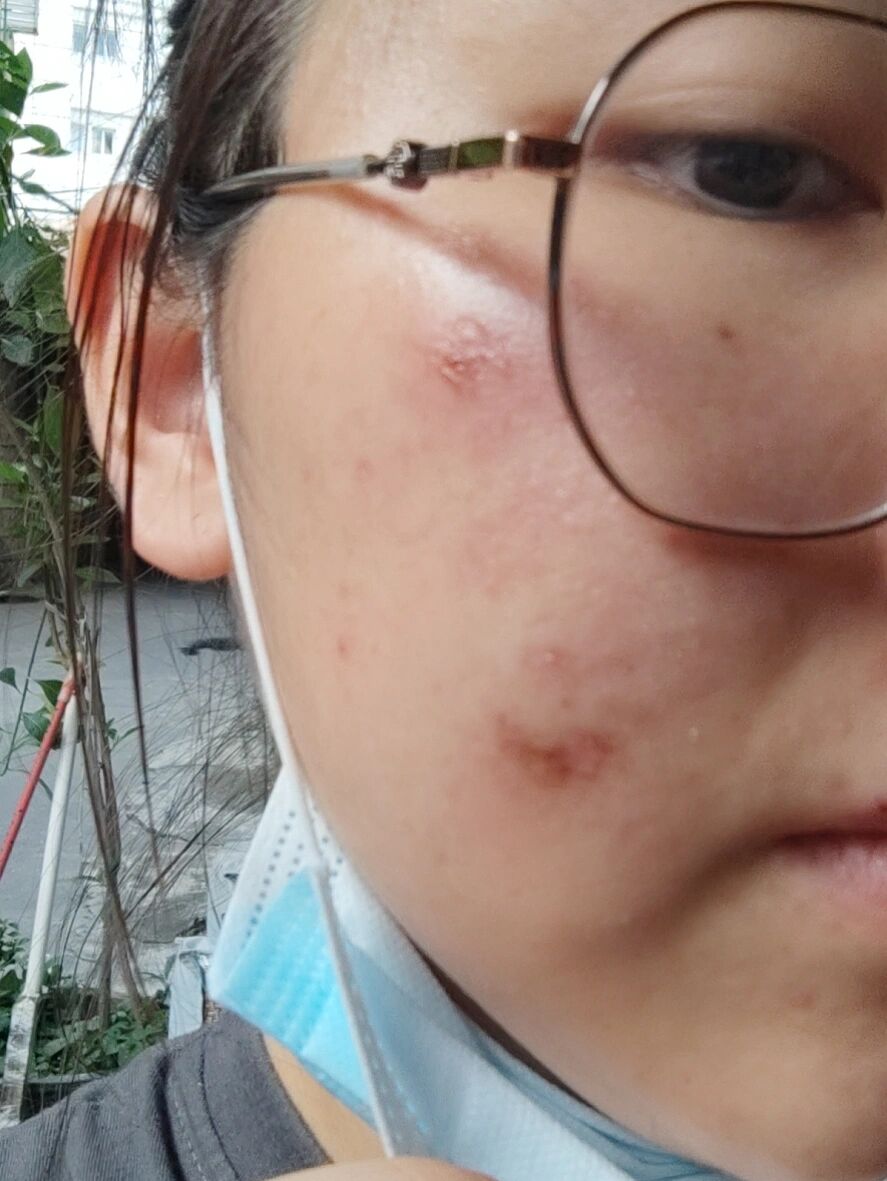 长痘痘烂脸了,在小红书搜了一下用夫西地酸软膏和红霉素软膏可以治痘