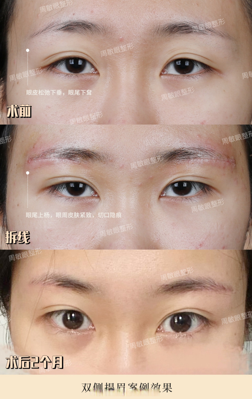 双侧提眉术后2个月随访 提眉手术的切口我们一般是选在眉毛下侧边缘