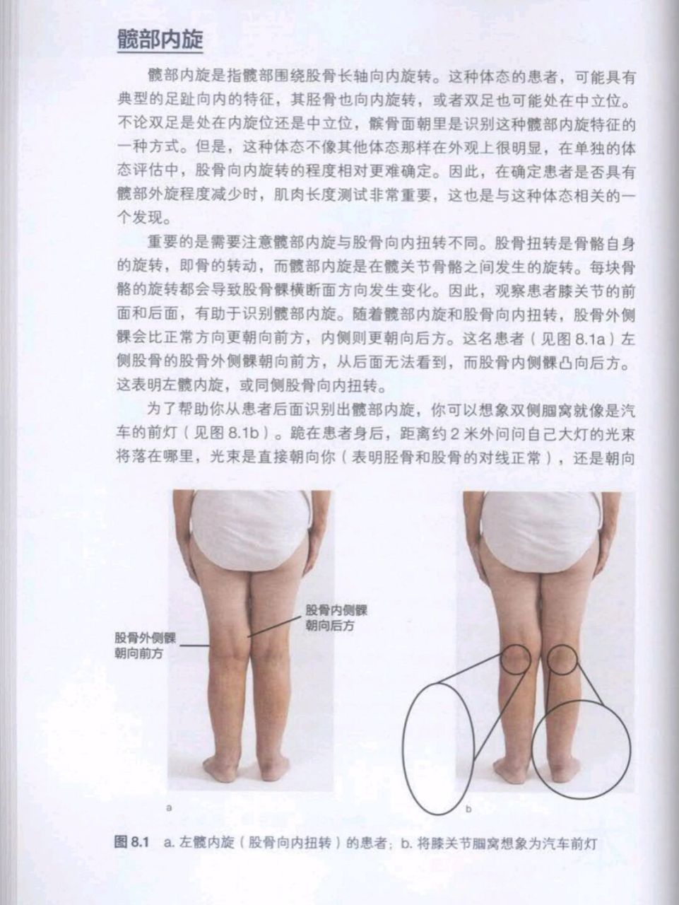 髋内旋(假胯宽,x型腿,扁平足) 1:大多数人髋内旋都是左腿更加内旋,长