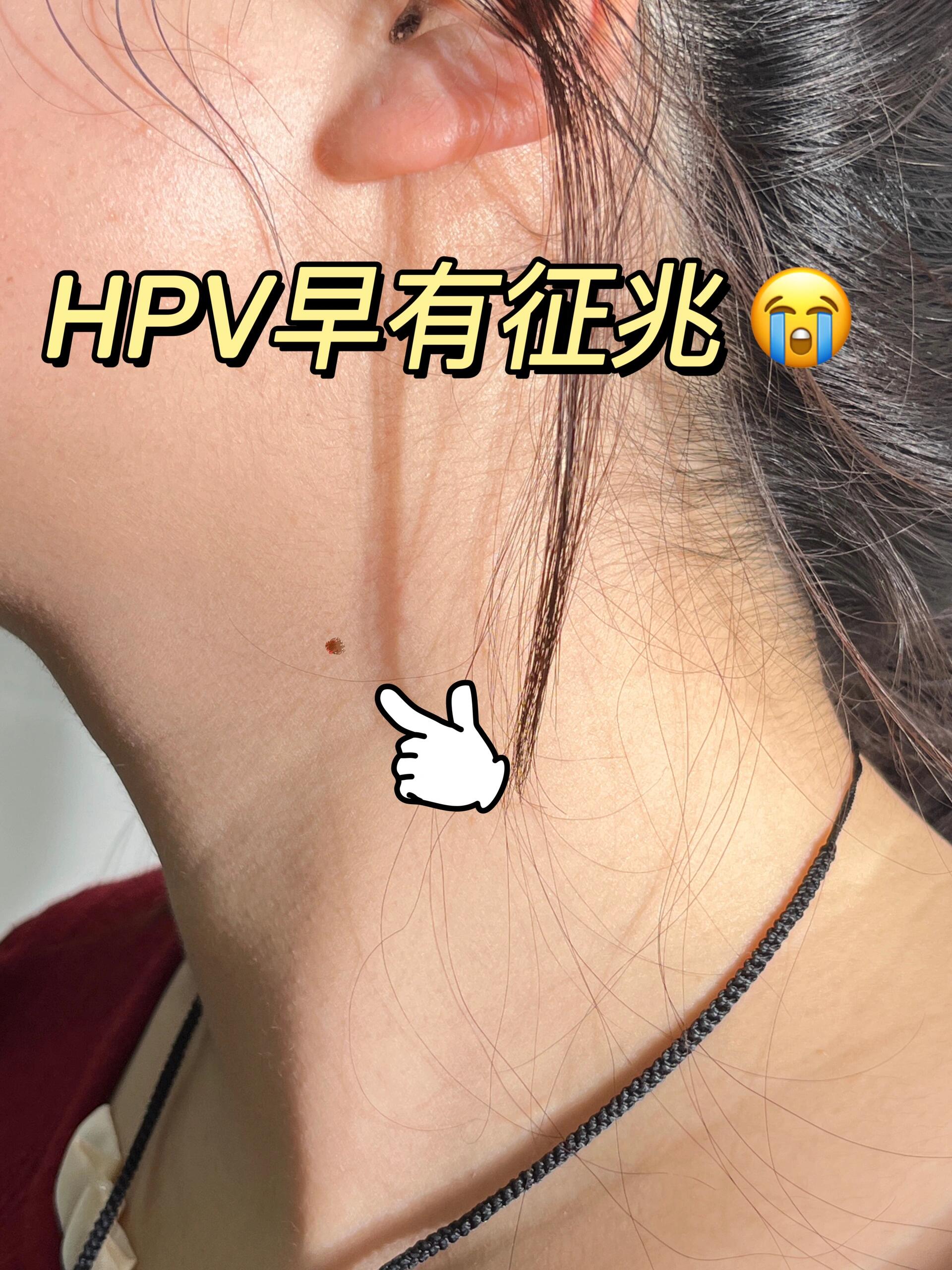 你可能已经感染了hpv,但自己却不知道!