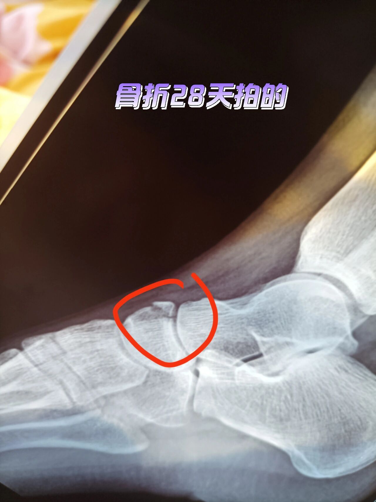 足舟骨骨折
