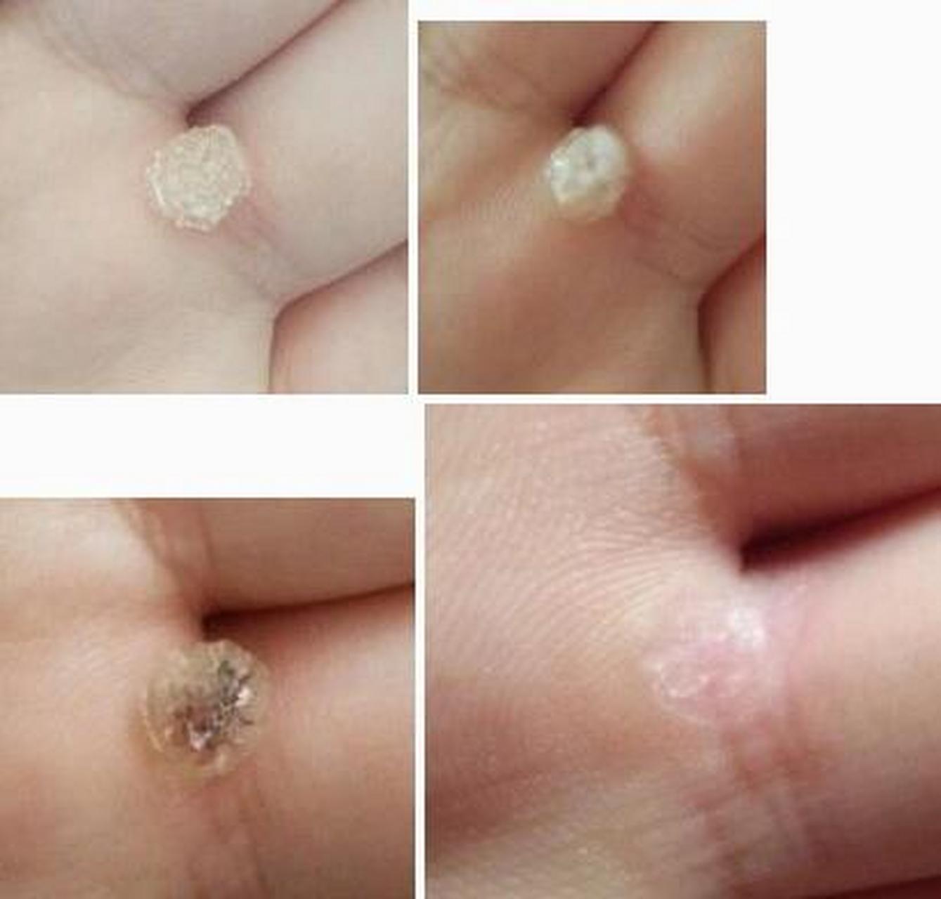 手指长的跖疣,不到俩月就好了,你敢信? 看着挺吓人,其实就是个纸老虎.