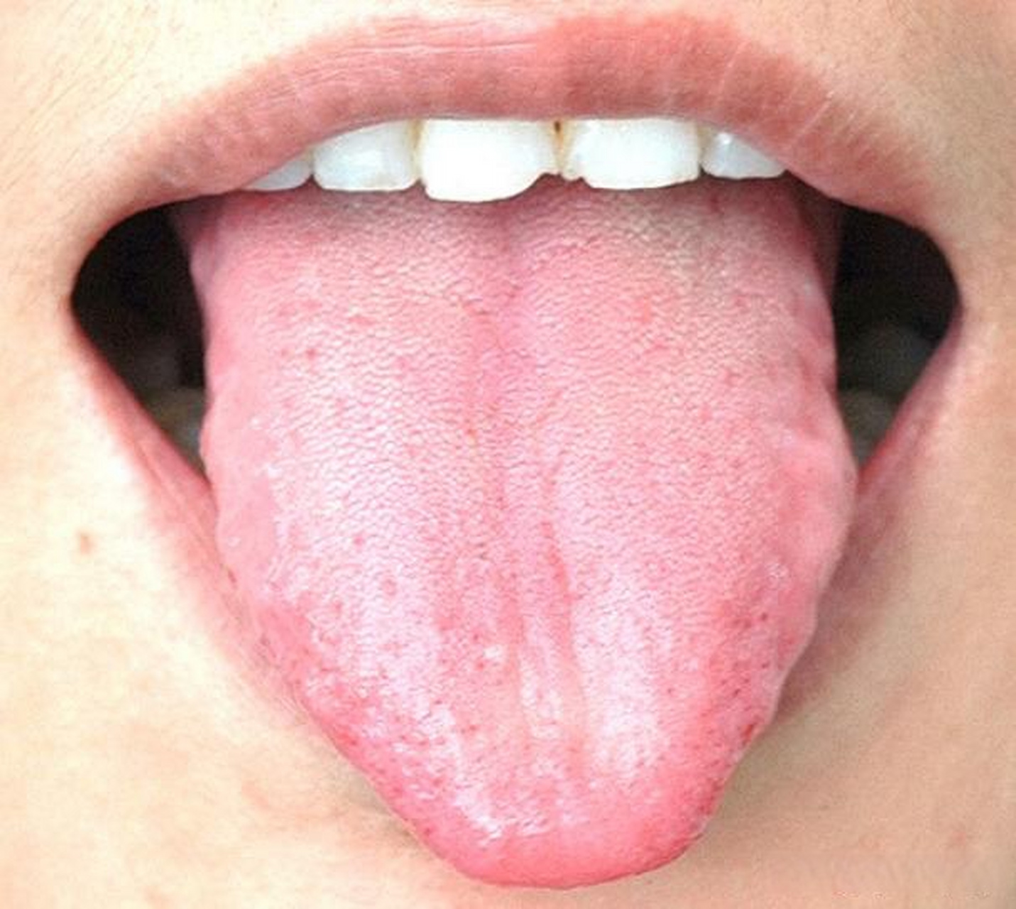 这是气虚淡白舌,常见症状:神疲乏力,面色淡白;少气懒言,咳喘无力;动则