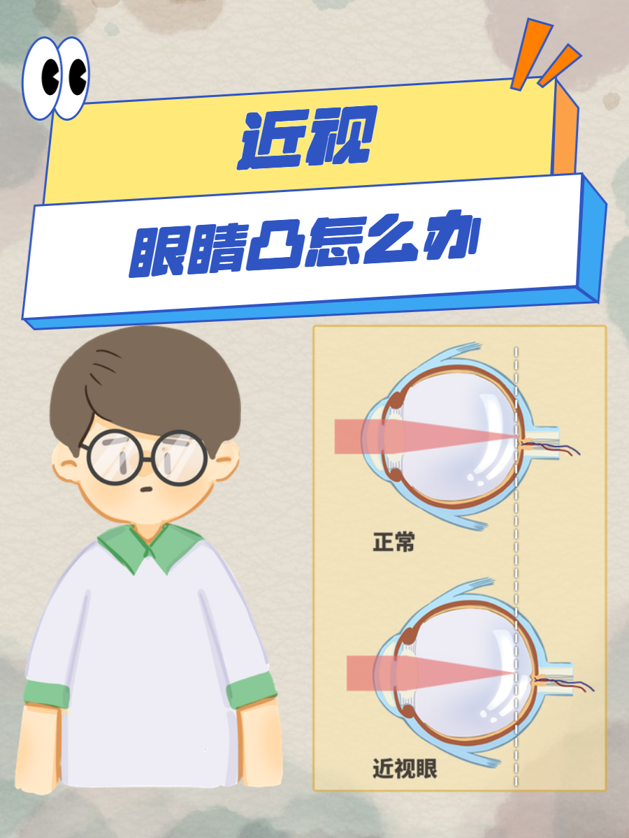近视眼睛凸是指眼睛因近视导致眼轴变长,使得眼球相对