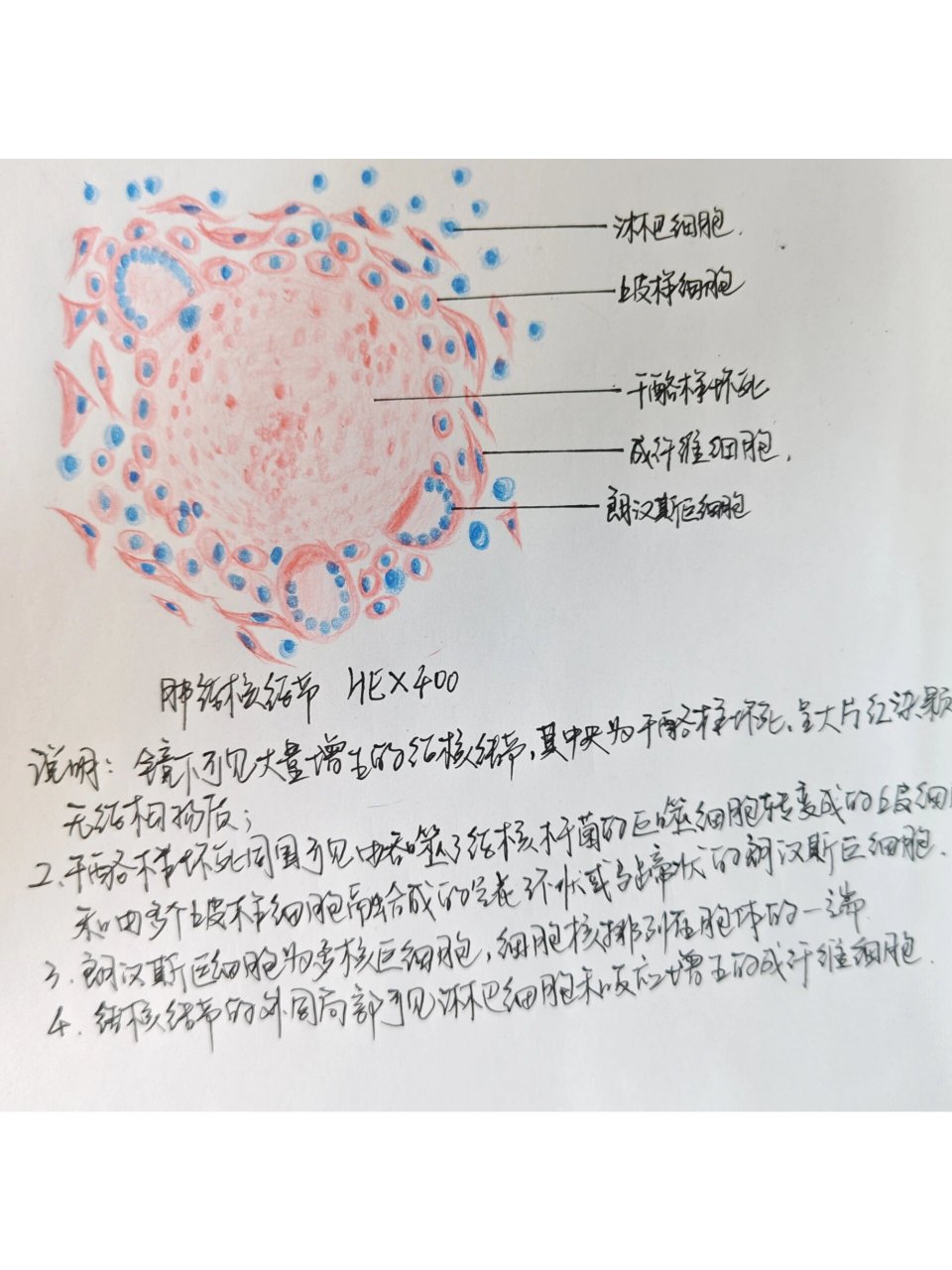 结核结节病理手绘图图片