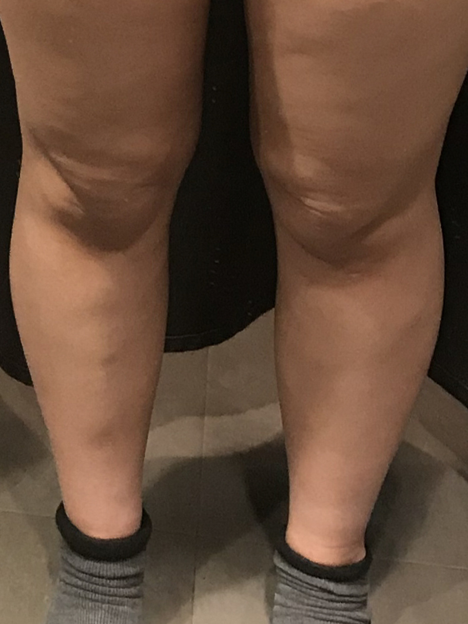 我的腿～大概是世界上最丑的05 小腿很短,而且小腿肌肉外翻,大腿