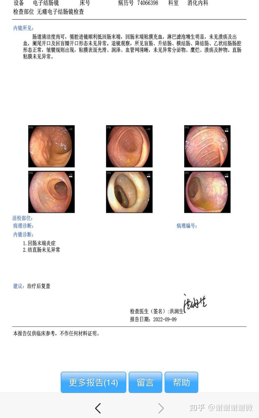 回肠末端淋巴滤泡增生图片