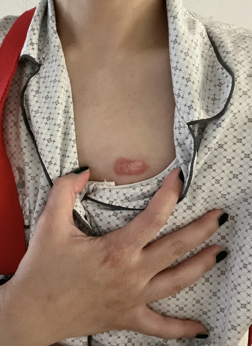 胸口长红色硬疙瘩,可能是毛囊炎,疖肿或者瘢痕疙瘩引起的