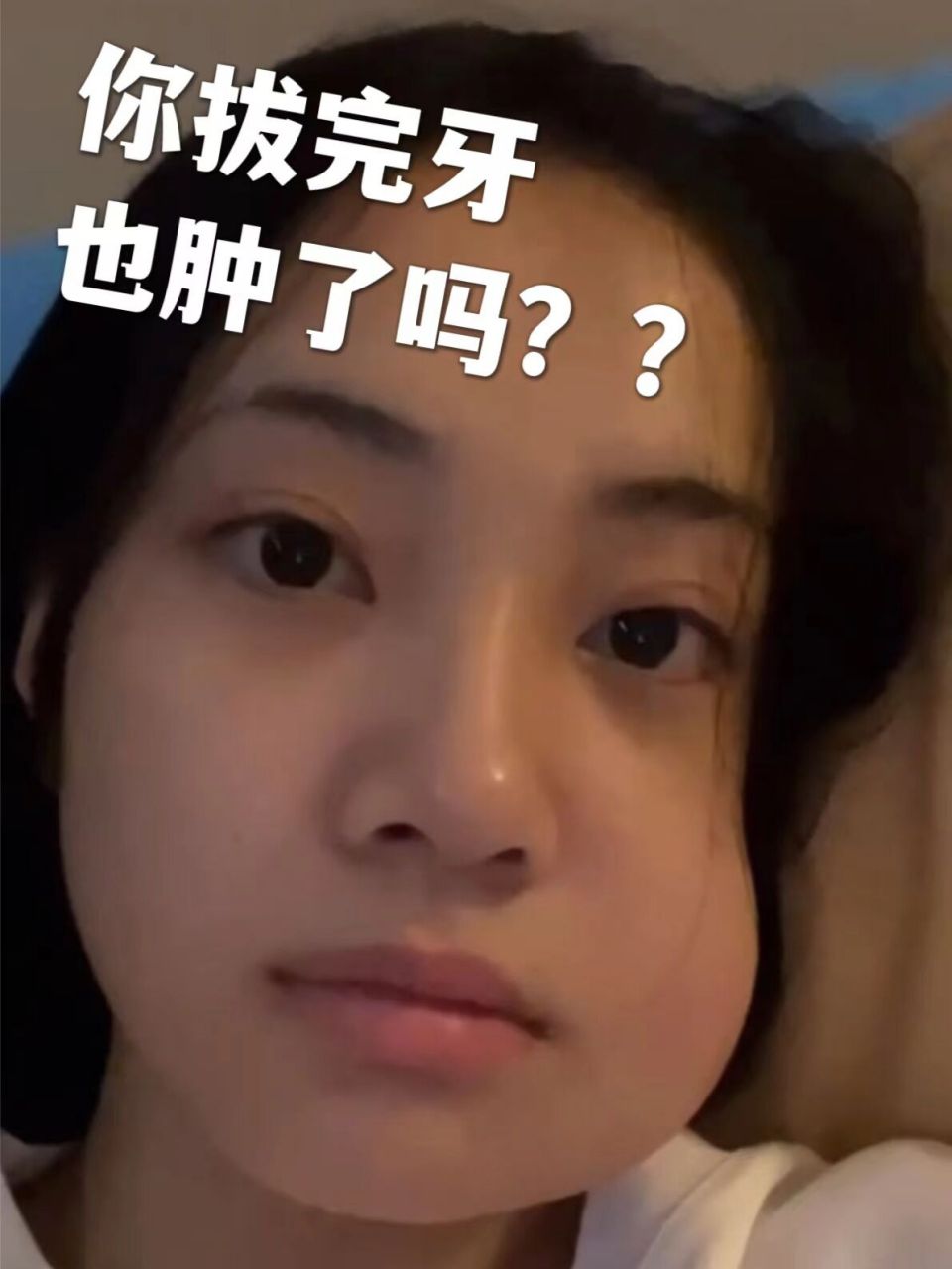 72 拔智齿不能瘦脸 再告诉你第二个绝望的消息 72 拔完牙肿不肿