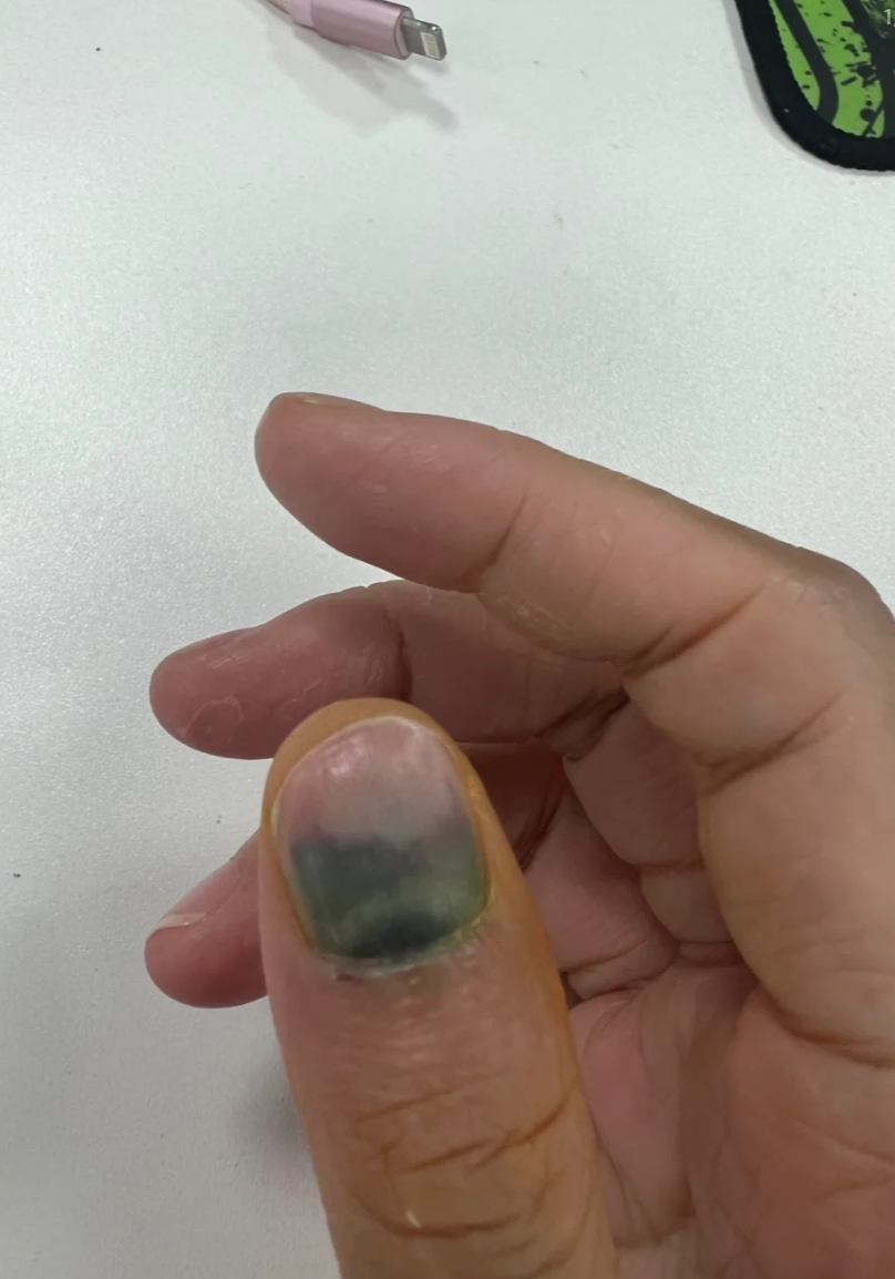 打球时戳到手指甲出现淤血,最常见的原因是外伤导致指甲下出血