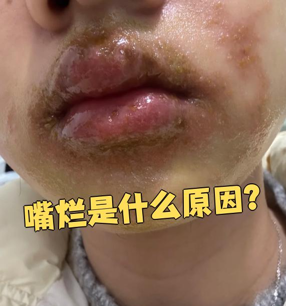 嘴烂可能由多种原因引起,常见的有精神因素,食物