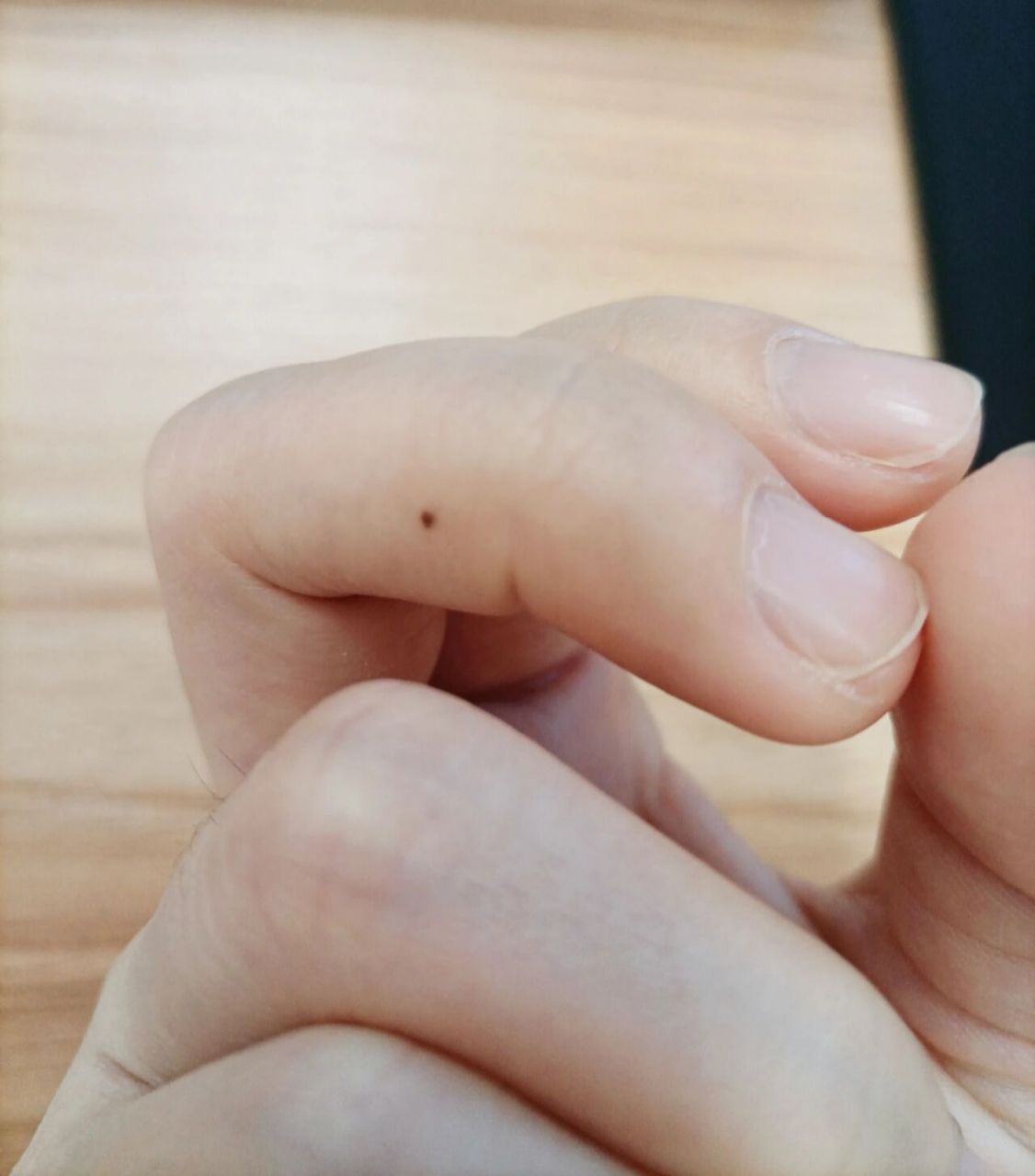 无意间发现自己手指上突然多了一颗痣,而且有越来越黑的趋势