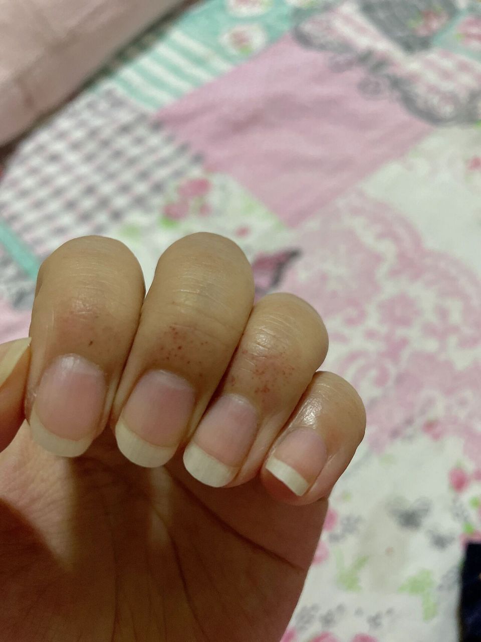 06手指根部总是有这些小红点 不知道就问,最近发现手指根部总会出现