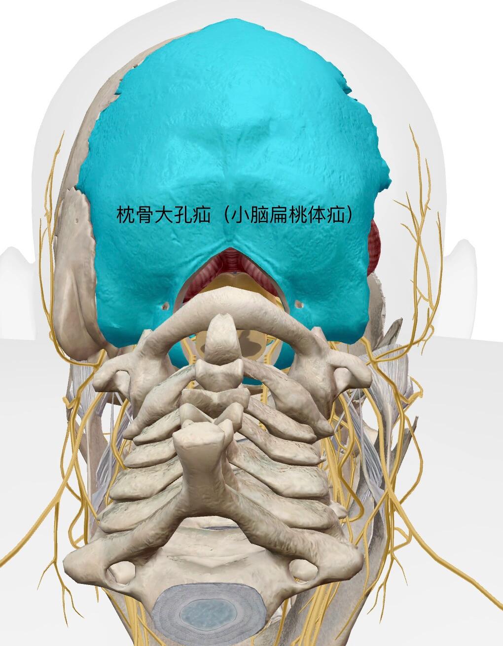 枕骨大孔疝位置图片图片