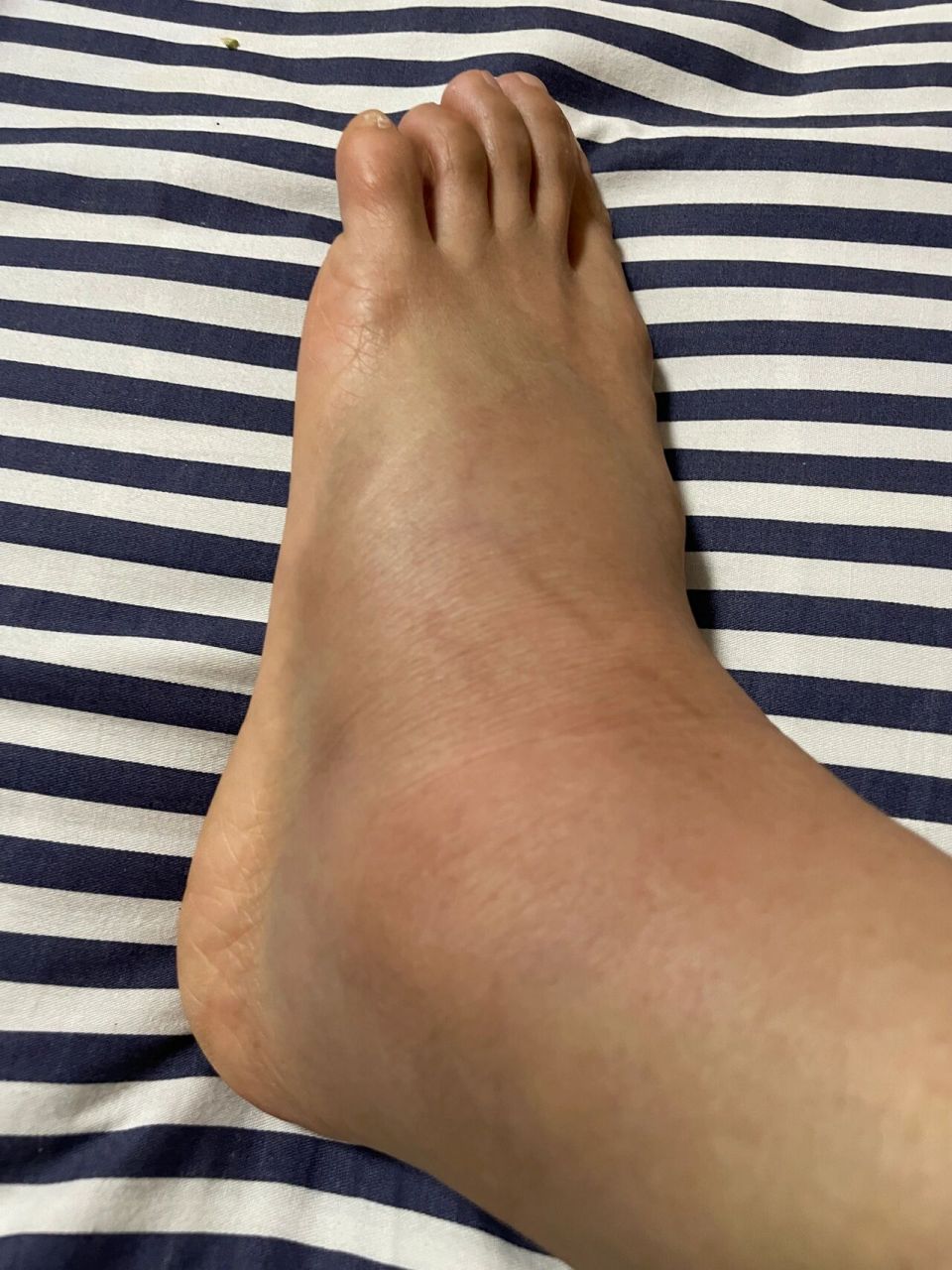 刚算好走几天,打羽毛球扭伤左脚,24小时内坚持冰敷