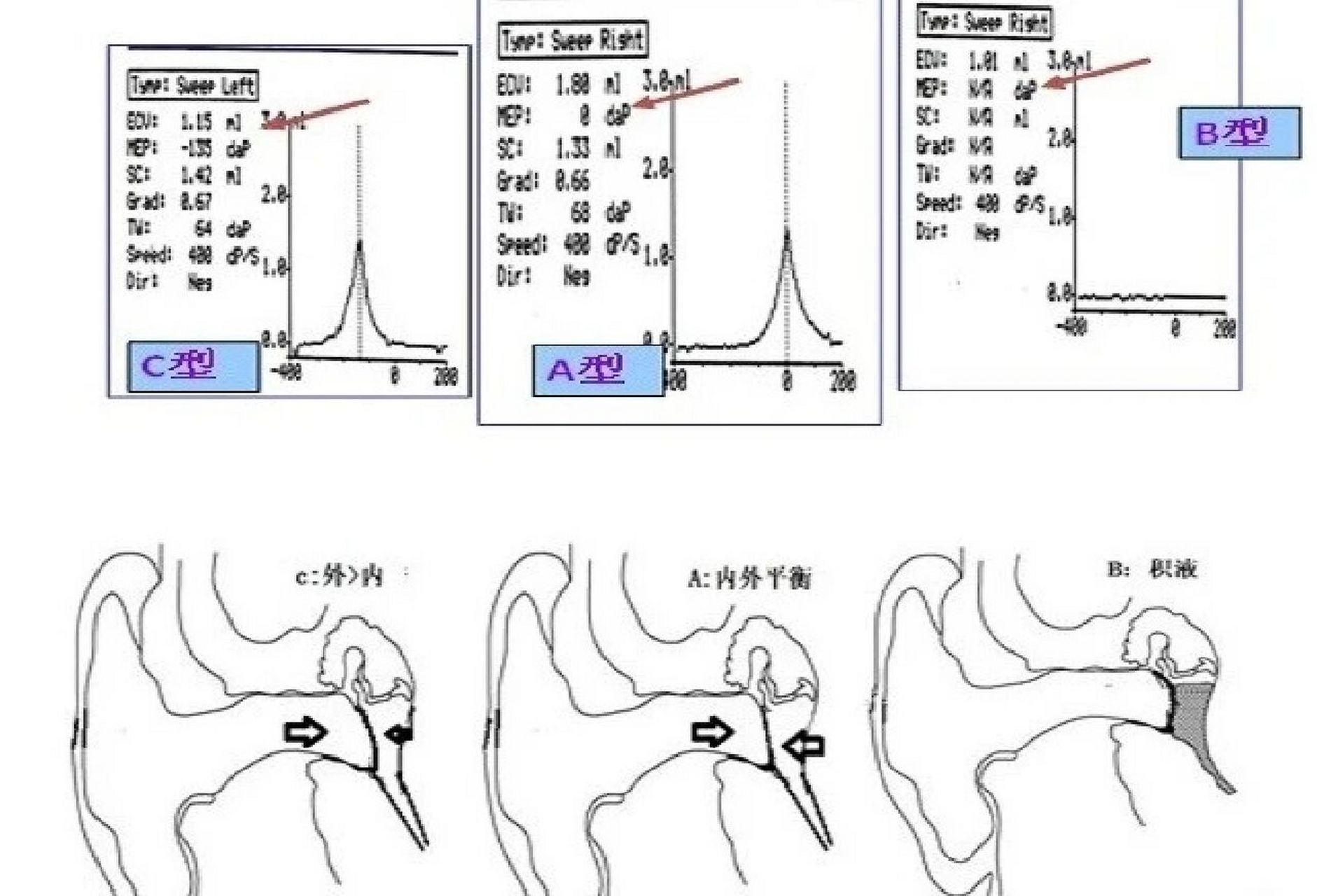 雅安聪茂助听器分享:如何看骨窒图 鼓室图的横坐标为外耳道压力(单位